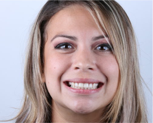 Diseño de sonrisa ANTES