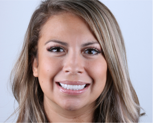 Diseño de sonrisa Depues