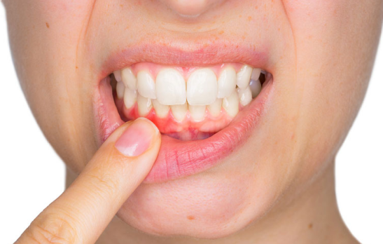 diseño de sonrisa