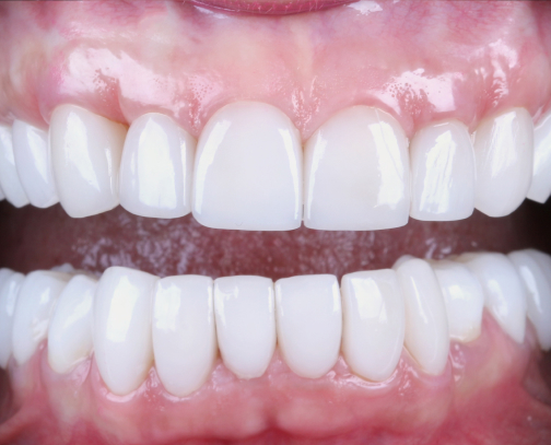 Diseño de sonrisa