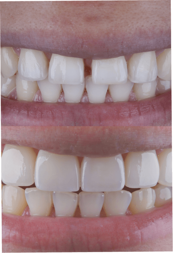 Diseño de sonrisa ceramica
