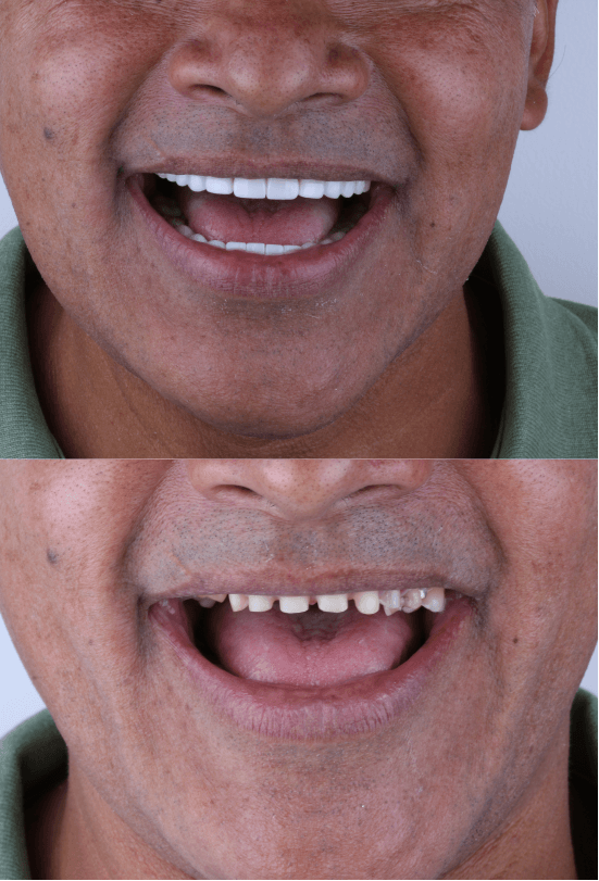 Diseño de sonrisa 

