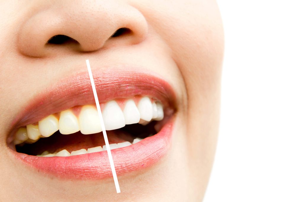 Antes y después de un blanqueamiento dental