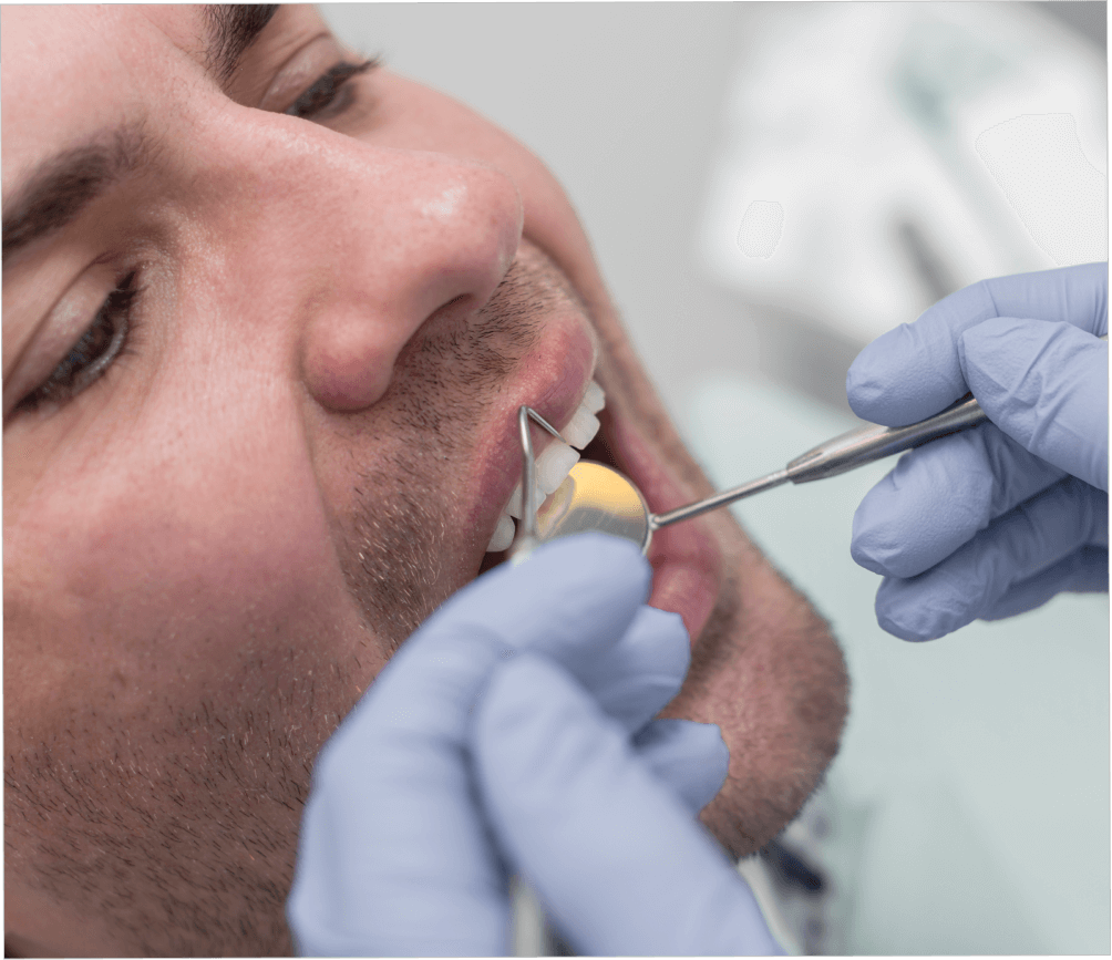 Ventajas de las resinas dentales