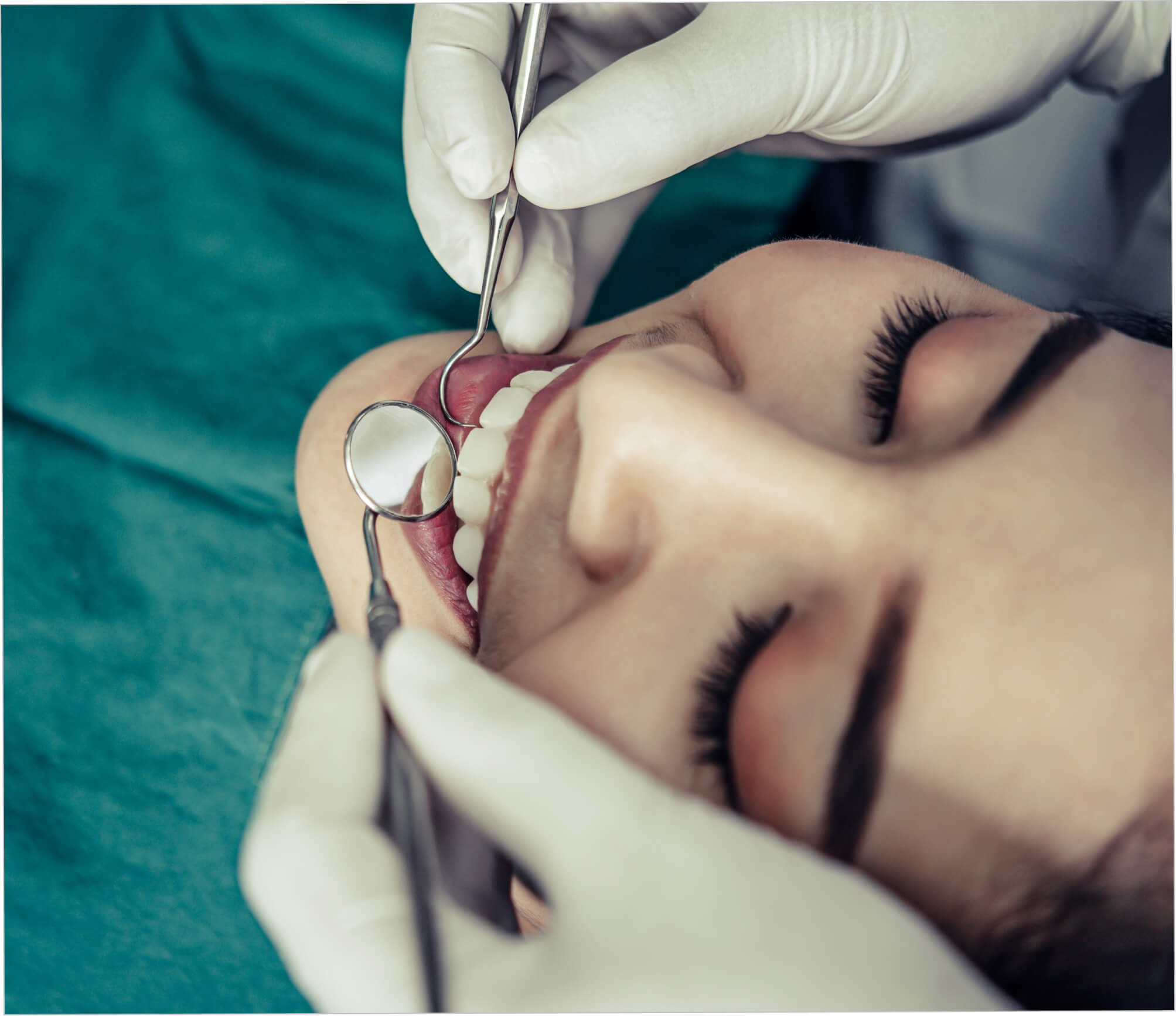 Obturación dental con resina de fotocurado