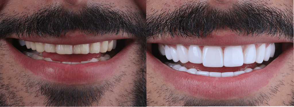 Diseño de sonrisa antes y después hombres 