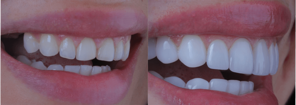 Diseño de sonrisa antes y después mujeres