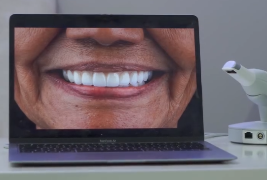 Prótesis dentales removibles
