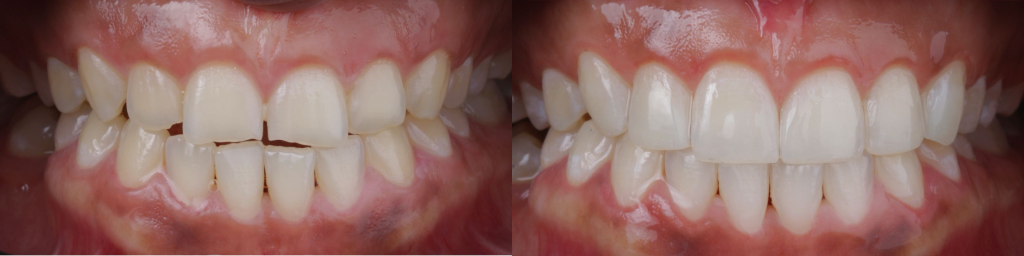 resina dental