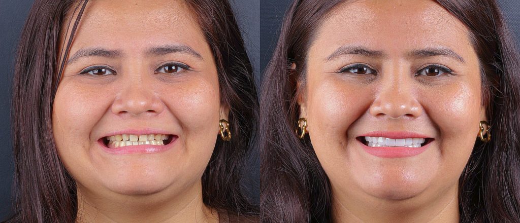 tipos de blanqueamiento dental