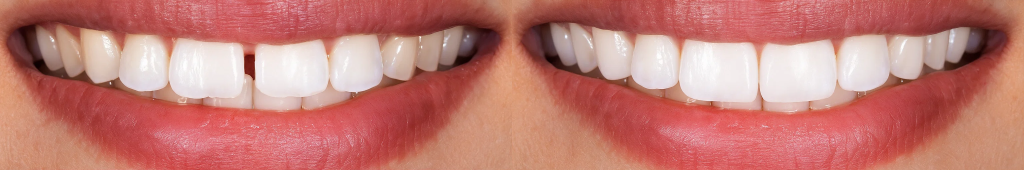 Diastema