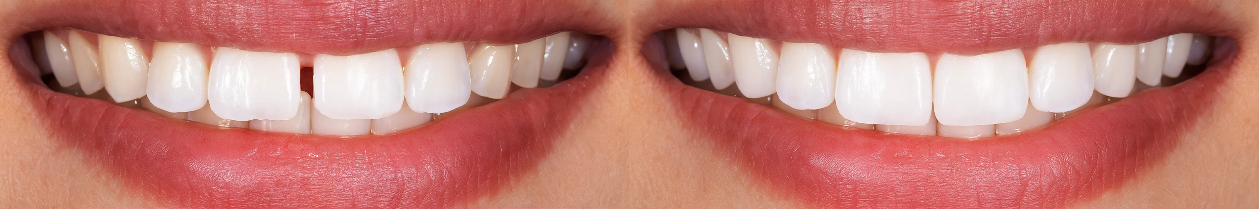 Diastema