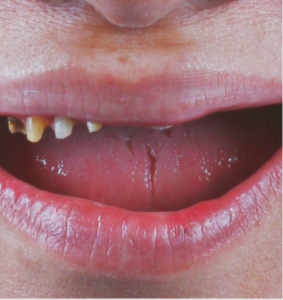 Antes--3