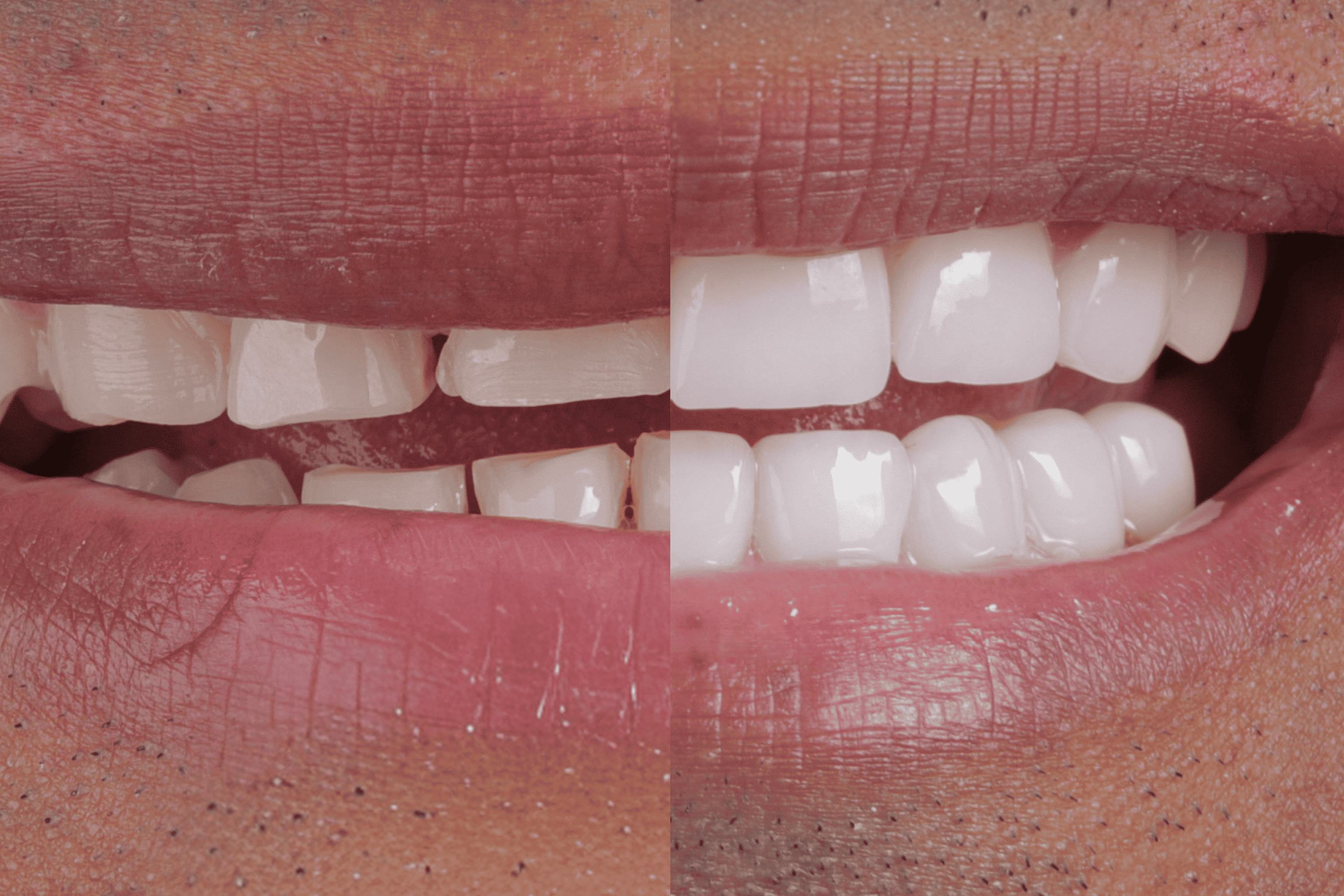 Diseño de sonrisa