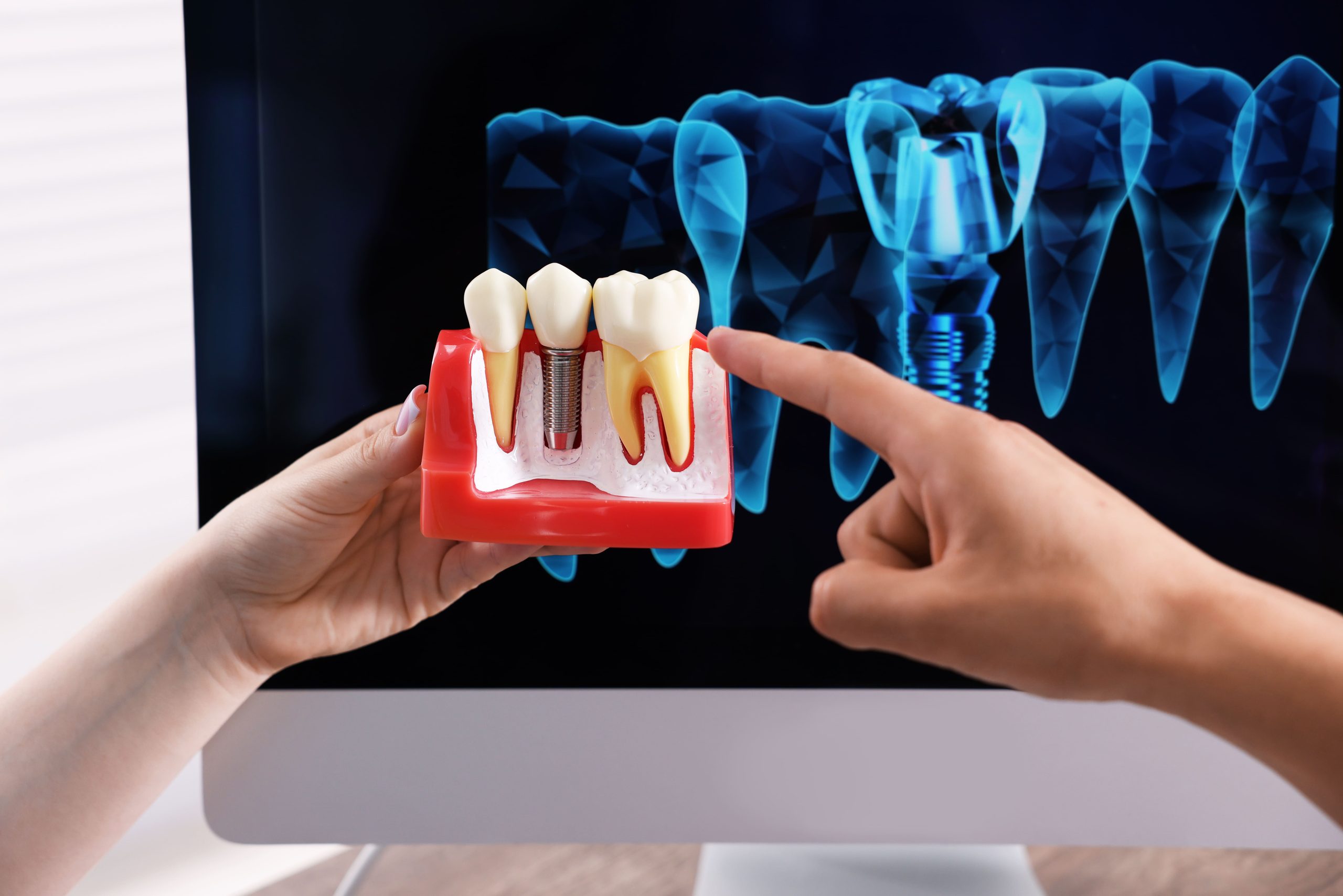 Implantes dentales en Barranquilla