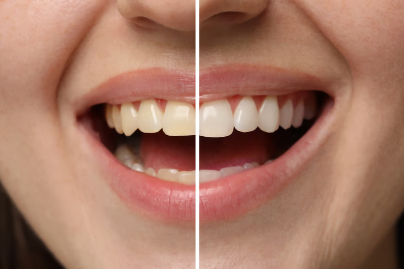 Blanqueamiento dental en Barranquilla