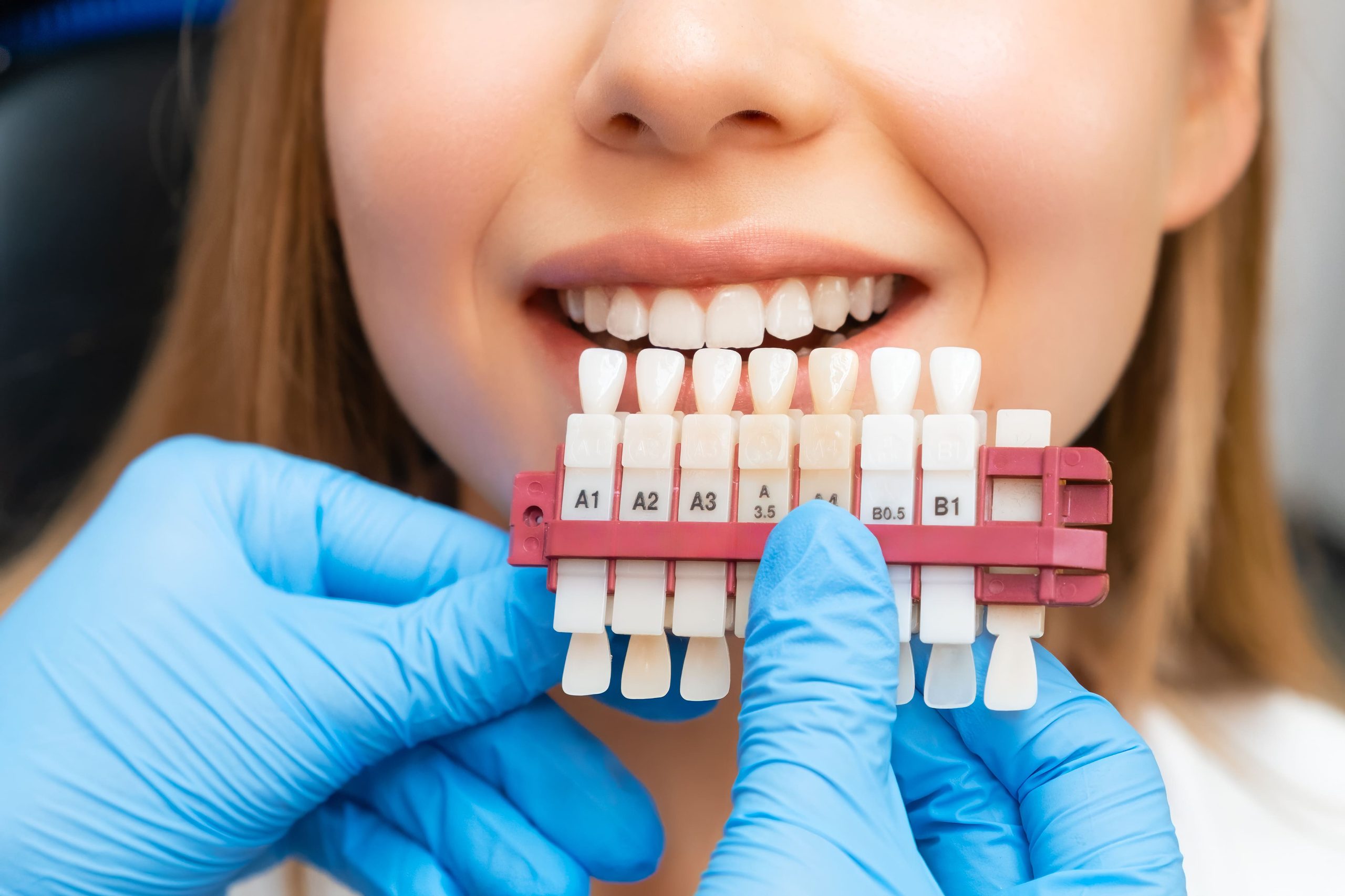 Blanqueamiento dental en Barranquilla