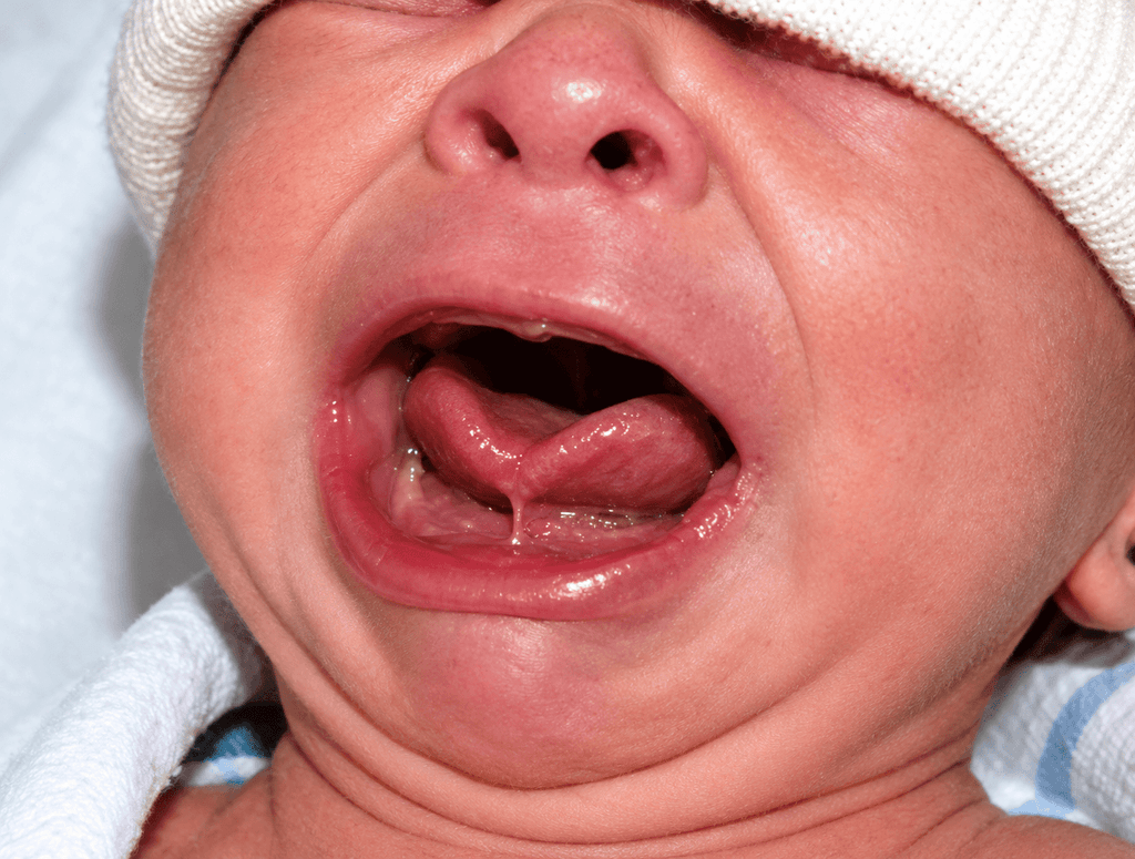 Anquiloglosia