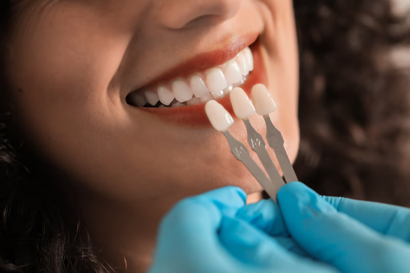 Carillas dentales en barranquilla