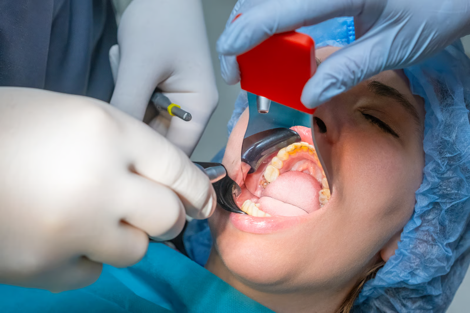 Sarro dental