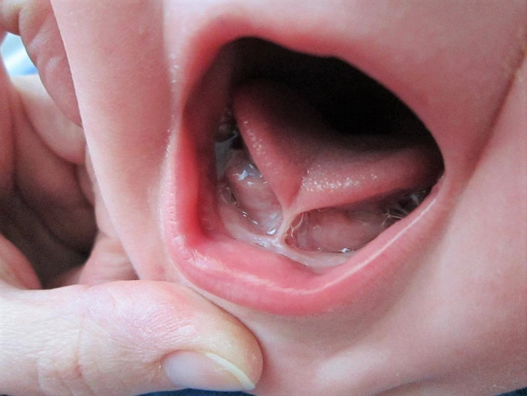 Anquiloglosia