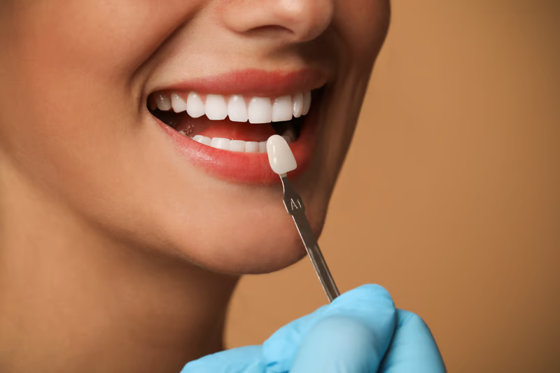 carillas dentales en barranquilla