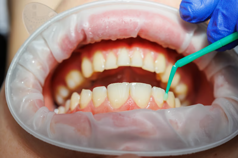 Gingivectomía